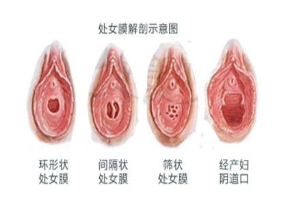 科普圖解：處女膜在陰道什麼位置